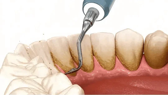 Dentify™ – Ultraljudsrengöring