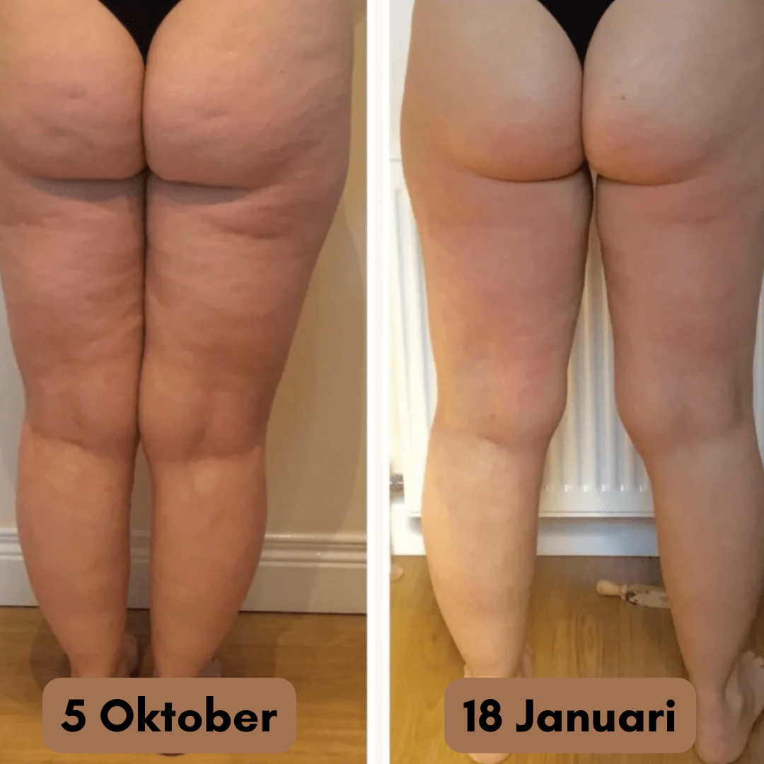 FormLegging™ - Den permanenta lösningen på dina celluliter