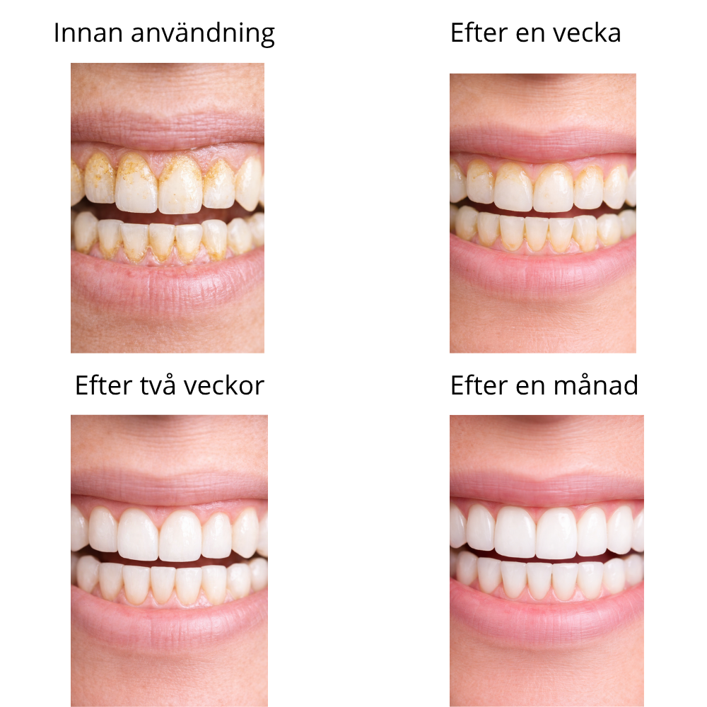 Dentify™ – Ultraljudsrengöring
