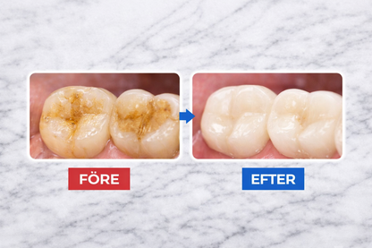 Dentify™ – Ultraljudsrengöring