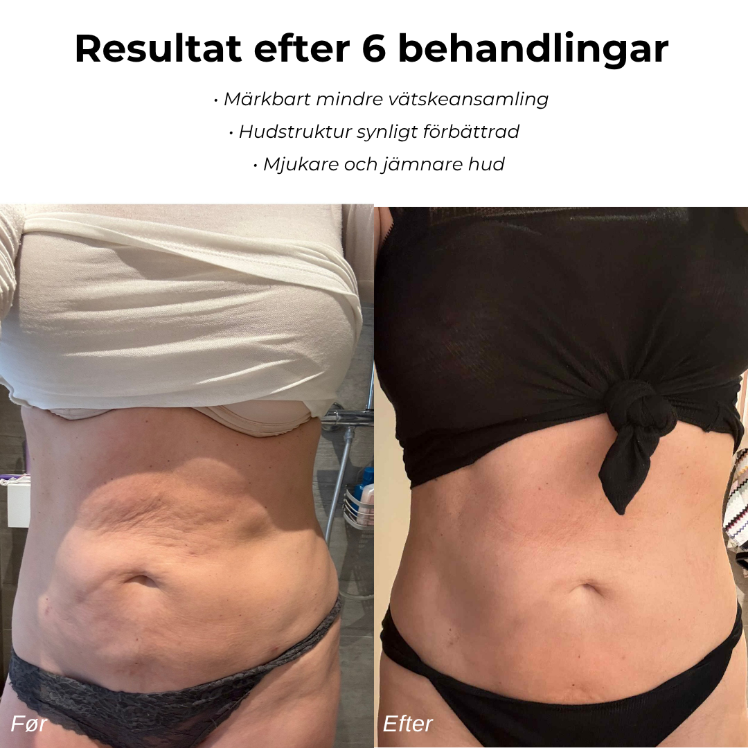 LindraForm Cellulit Borttagare