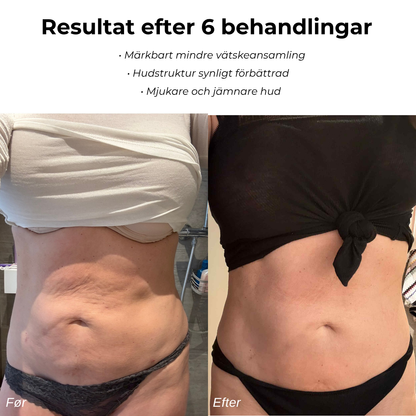 LindraForm Cellulit Borttagare