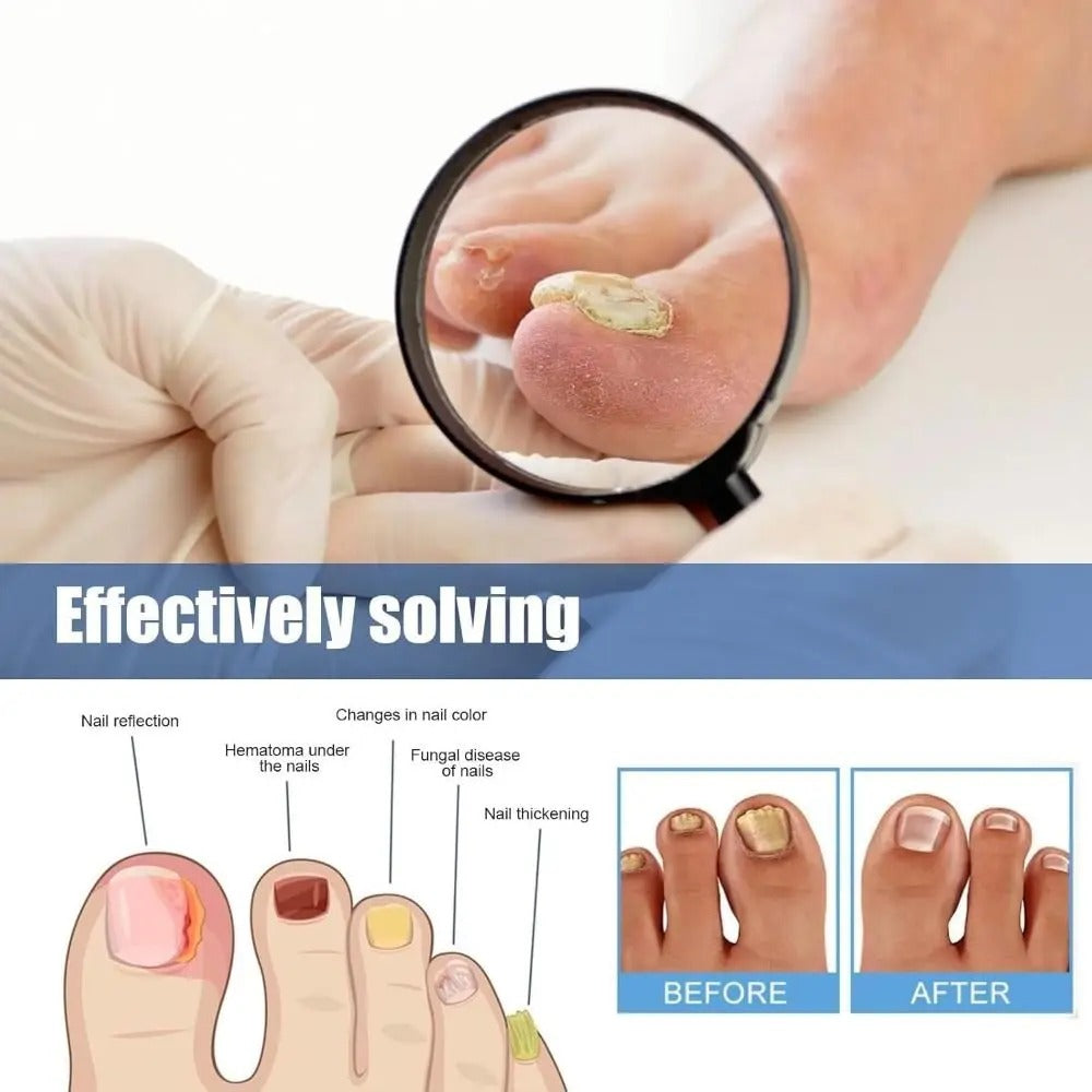 KlarNagel™ - Antibakteriellt och svampdödande plåster samt nagelvårdspaket