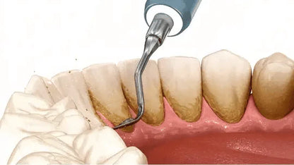 Dentify™ – Ultraljudsrengöring